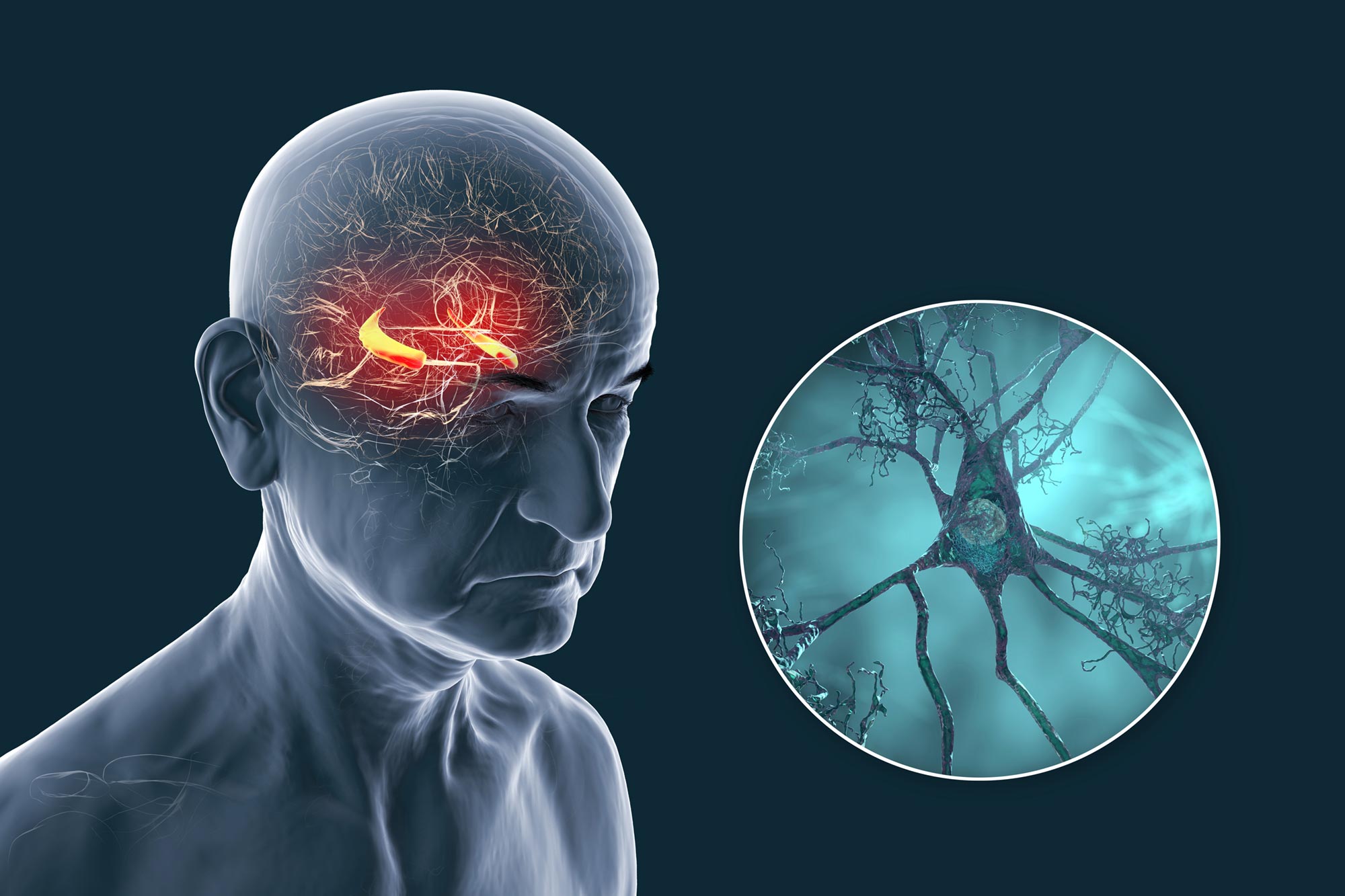 新しい研究はアルツハイマー病の理論に疑問を投げかける:プラークだけの問題ではない