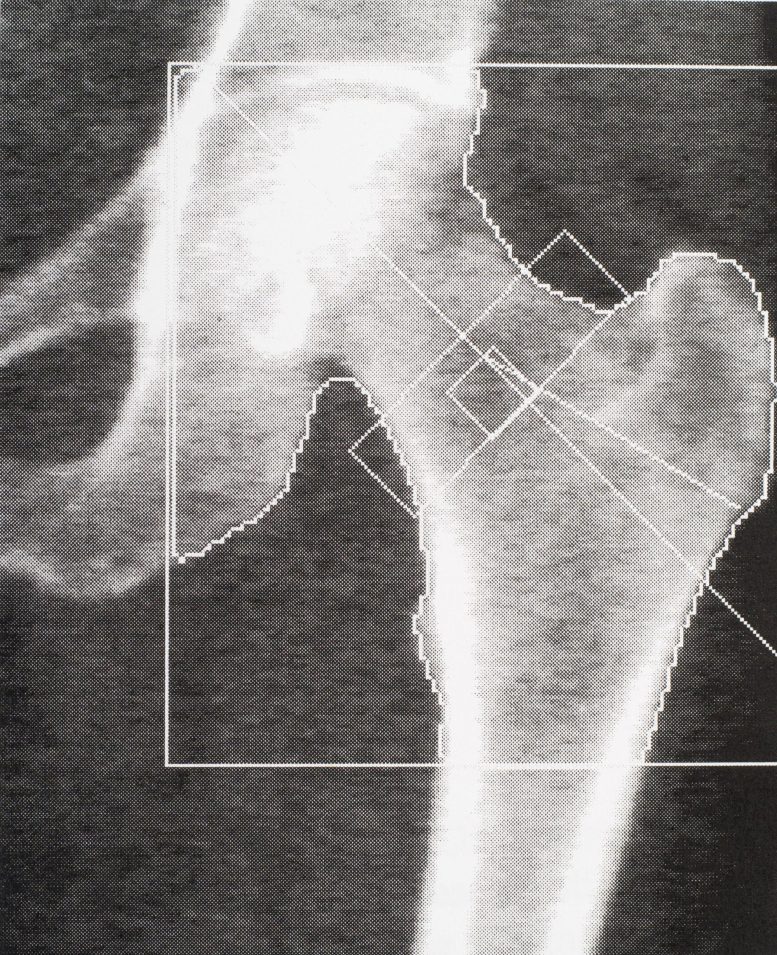Bone Density Medical Scan