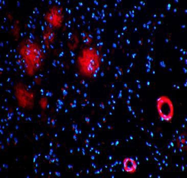 Researchers Report a Major Breakthrough in Alzheimer's Disease